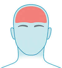 Céphalées en grappe